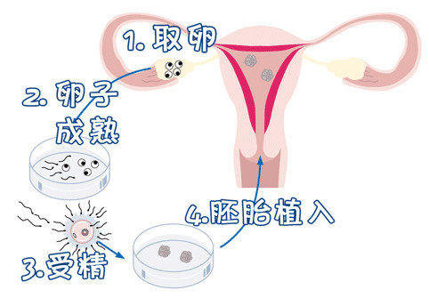 安孕冻胚移植专科